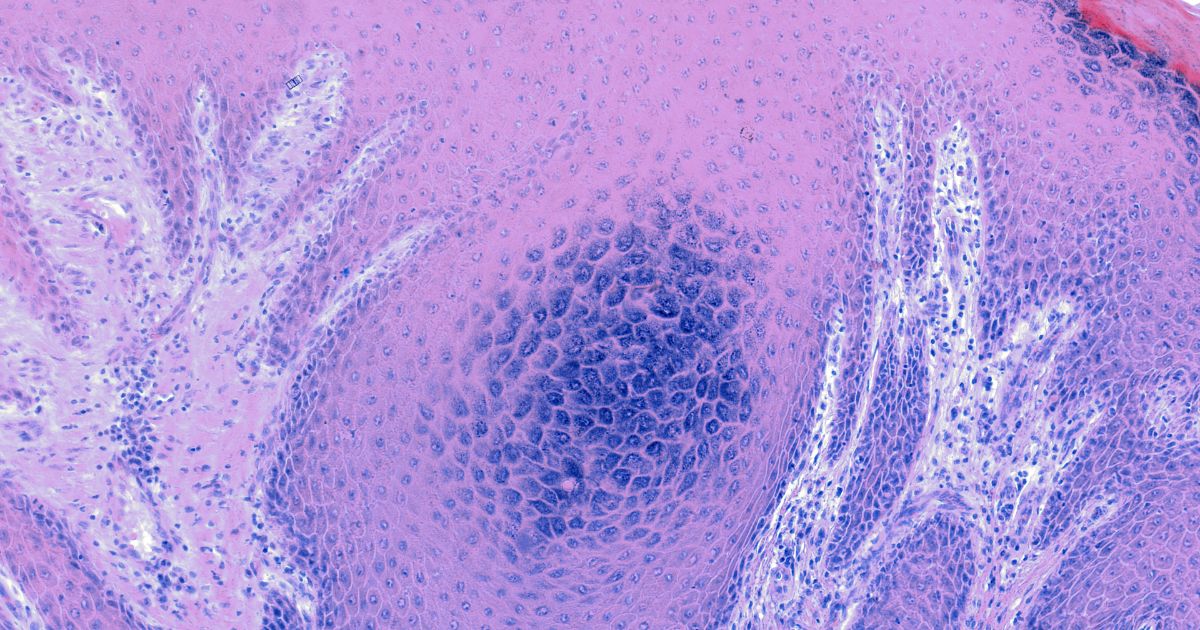 wirus brodawczaka ludzkiego hpv mikroskop foto