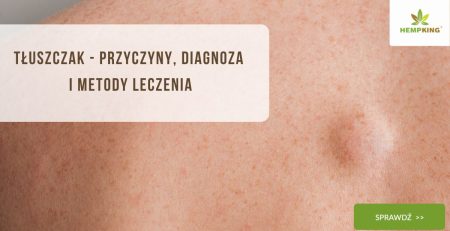 Tłuszczak - przyczyny, diagnoza i metody leczenia - obrazek wyróżniający