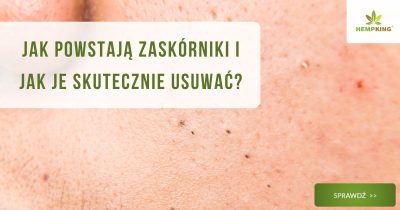Jak powstają zaskórniki i jak je skutecznie usuwać? - obrazek wyróżniający