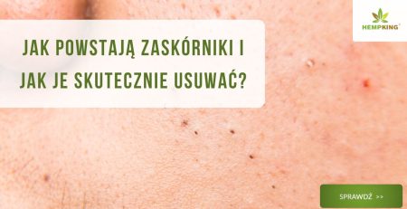 Jak powstają zaskórniki i jak je skutecznie usuwać? - obrazek wyróżniający