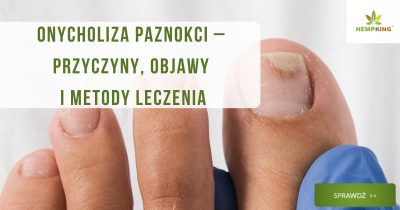Onycholiza paznokci przyczyny, objawy, leczenie - obrazek wyróżniający