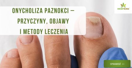 Onycholiza paznokci przyczyny, objawy, leczenie - obrazek wyróżniający