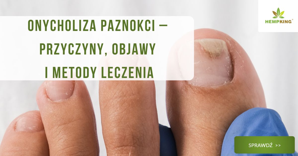 Onycholiza paznokci przyczyny, objawy, leczenie - obrazek wyróżniający