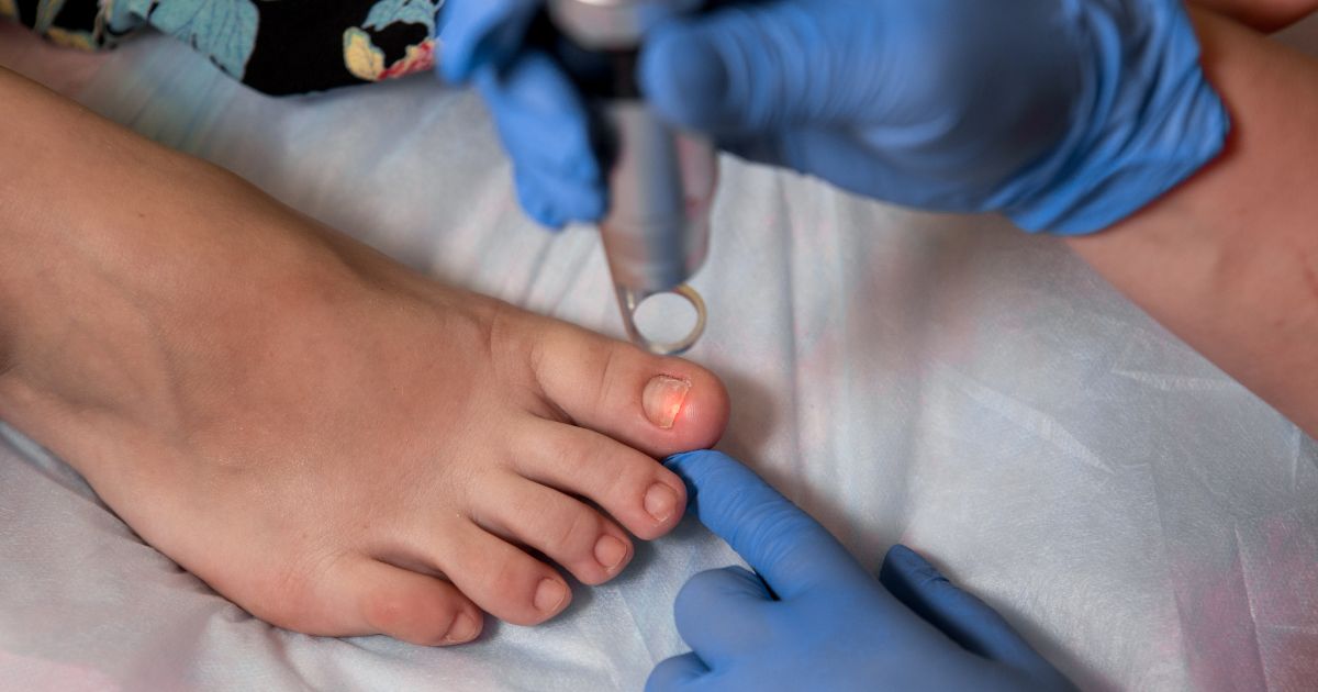 Onycholiza leczenie - zdjęcie poglądowe