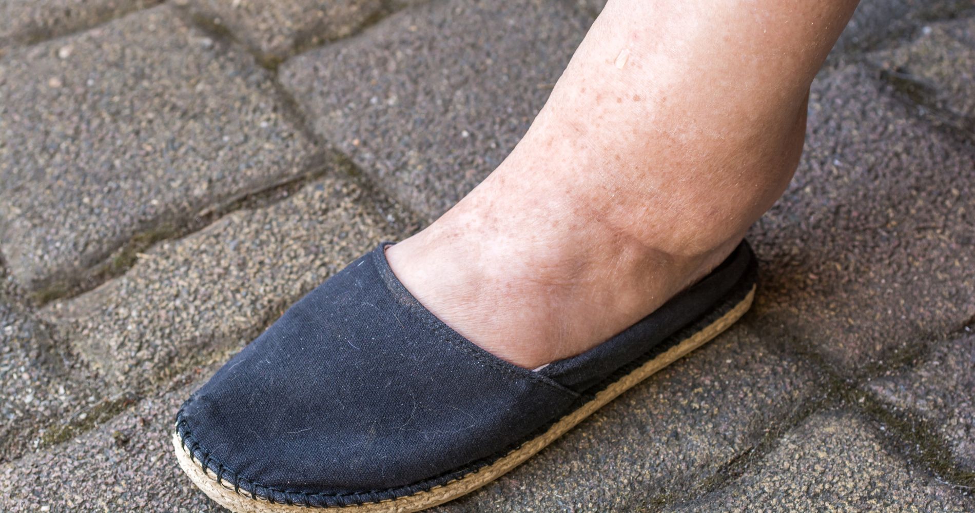 Obrzęk kostki jako objaw nadmiaru wody w organizmie.