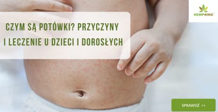 Czym są potówki Przyczyny i leczenie u dzieci i dorosłych - obrazek wyróżniający