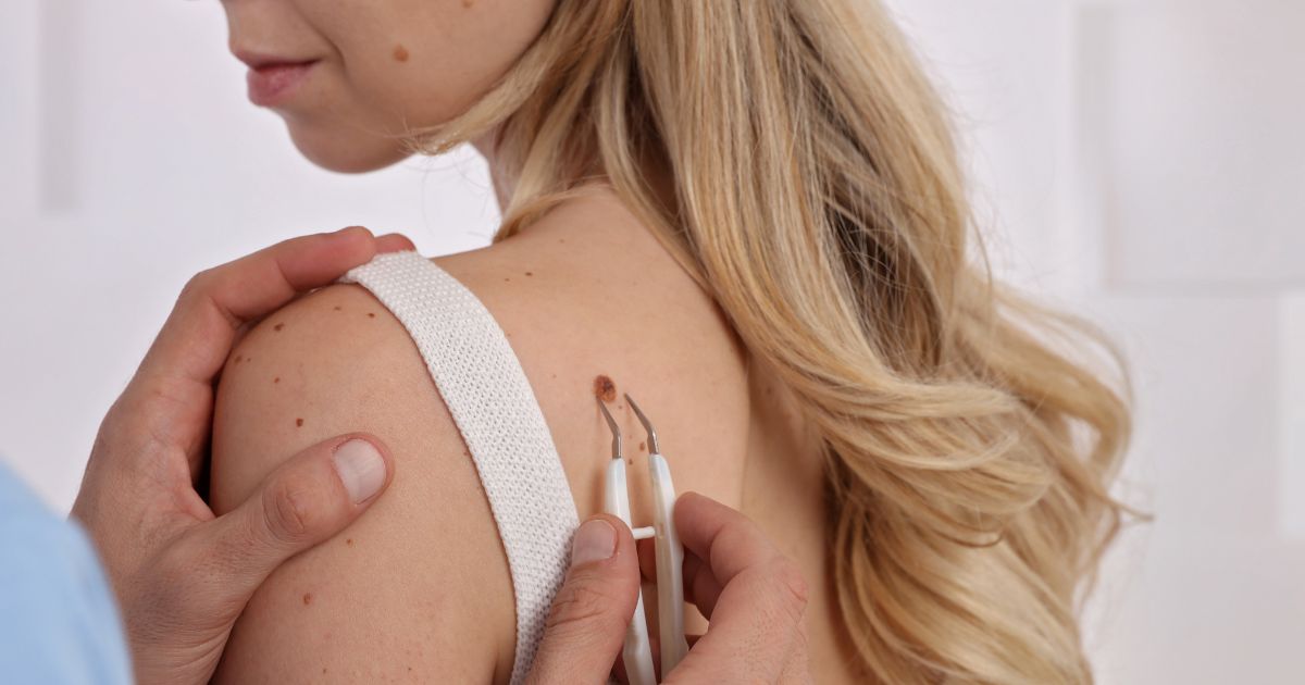 Badanie zmian skórnych - zdjęcie poglądowe