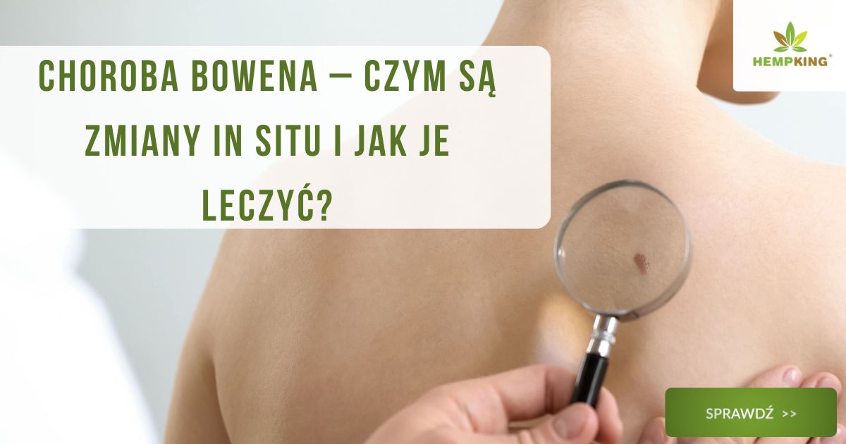 Choroba Bowena – czym są zmiany in situ i jak je leczyć? - obrazek wyróżniający