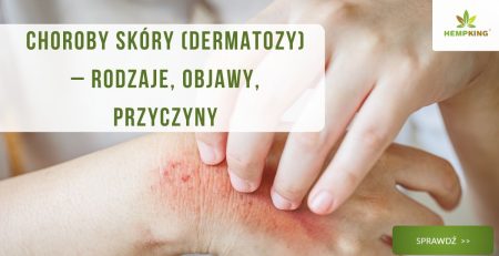 Choroby skóry (dermatozy) – rodzaje, objawy, przyczyny - obrazek wyróżniający