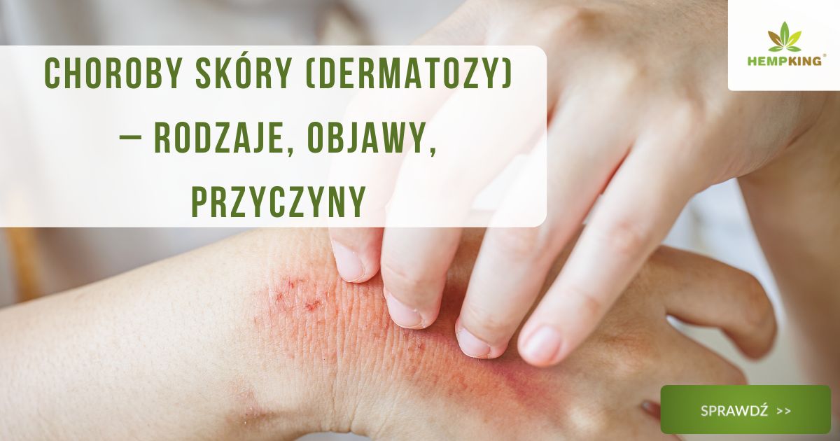 Choroby skóry (dermatozy) – rodzaje, objawy, przyczyny - obrazek wyróżniający