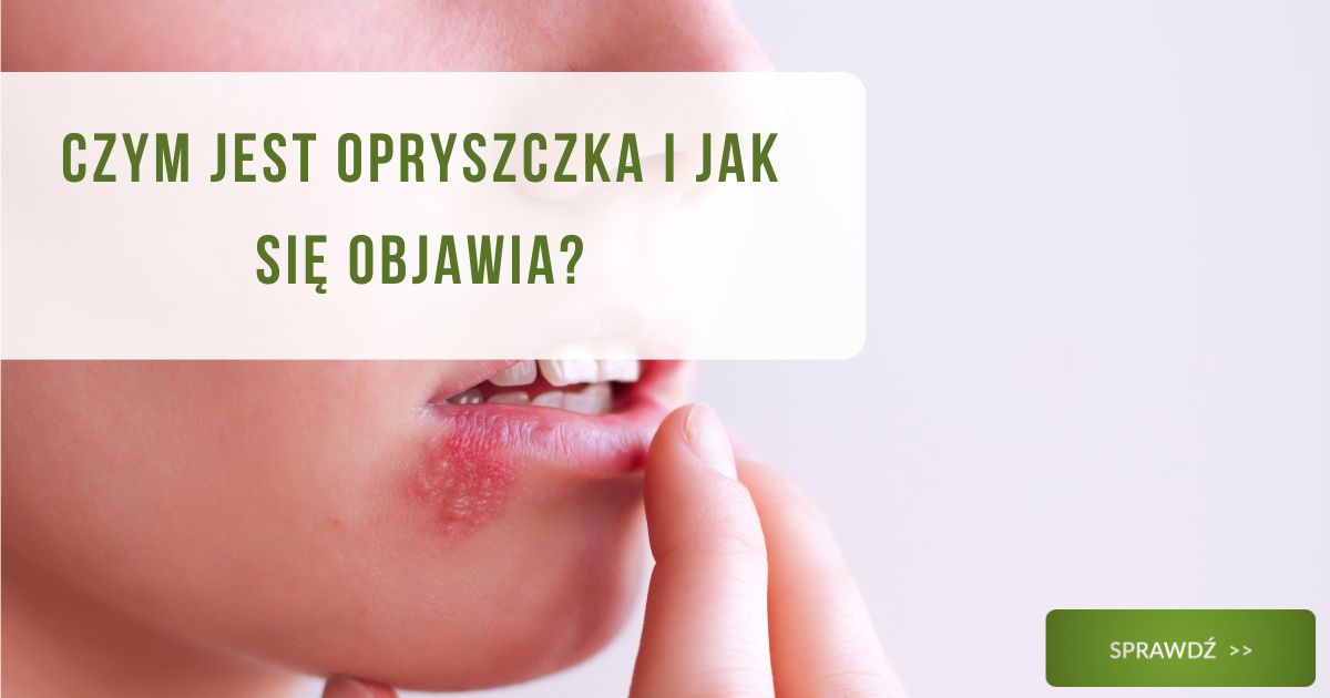 Czym jest opryszczka i jak się objawia? - obrazek wyróżniający