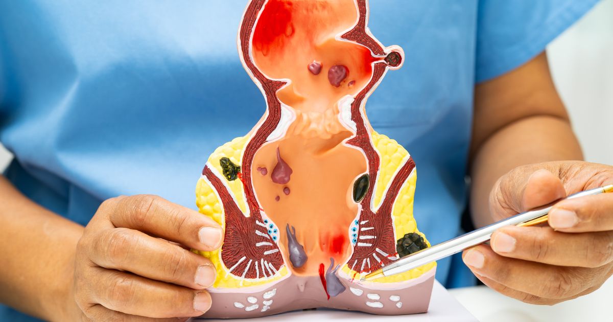 hemoroidy - zdjęcie poglądowe