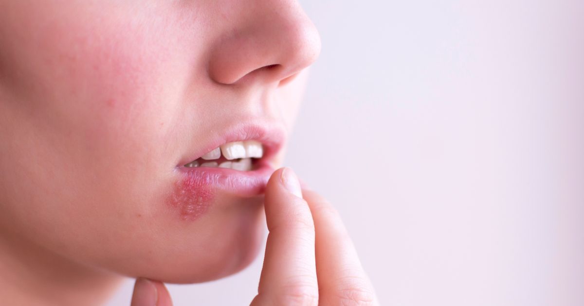 Opryszczka - zdjęcie poglądowe