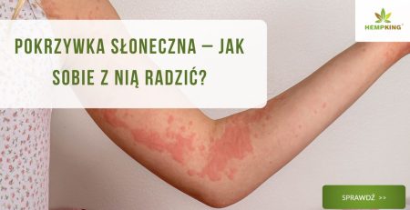 Pokrzywka słoneczna – jak sobie z nią radzić? - obrazek wyróżniający